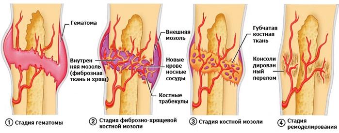 заживление костной мозоли