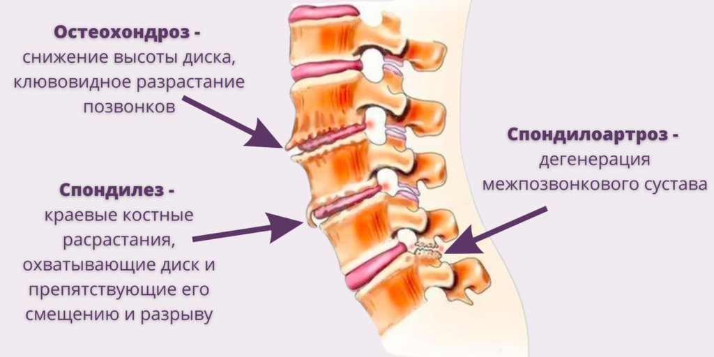 Артроз (ошибочное название для многих людей остеохондроз) суставов: почему возникает и как лечить?