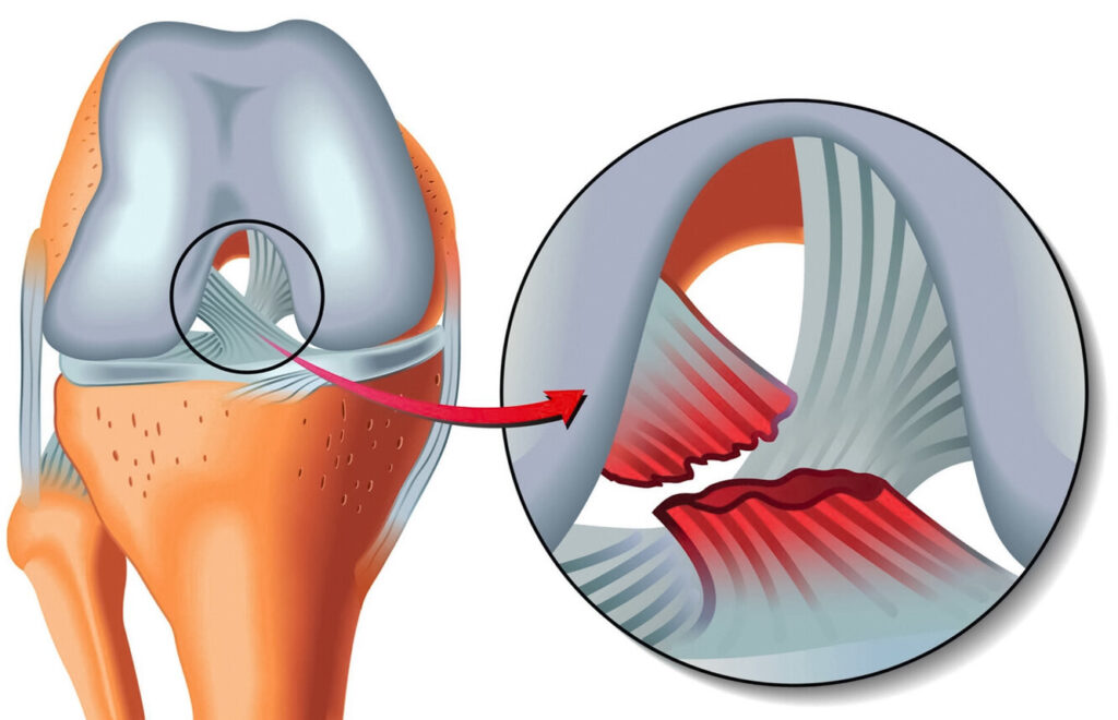 Как предотвратить травму связок колена?